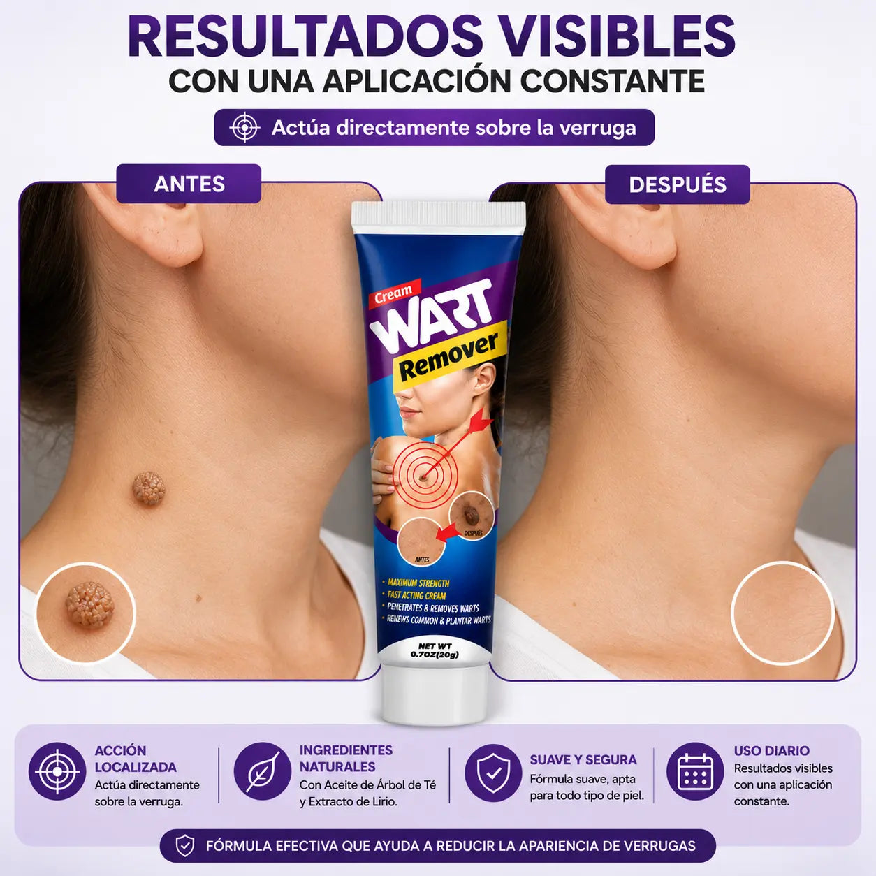 Hanel® | Crema Removedora de Verrugas
